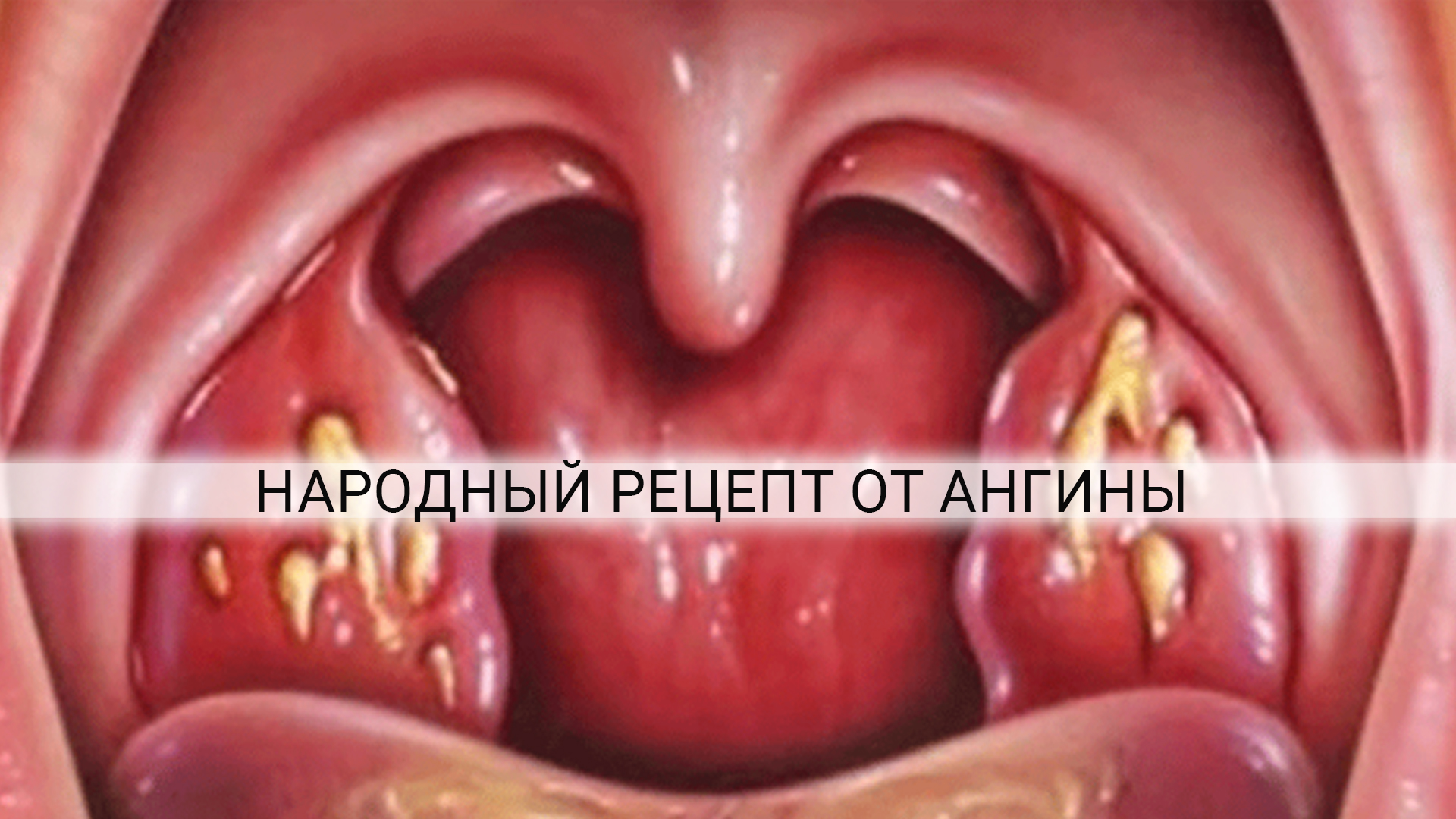 Вылечить ангину быстро